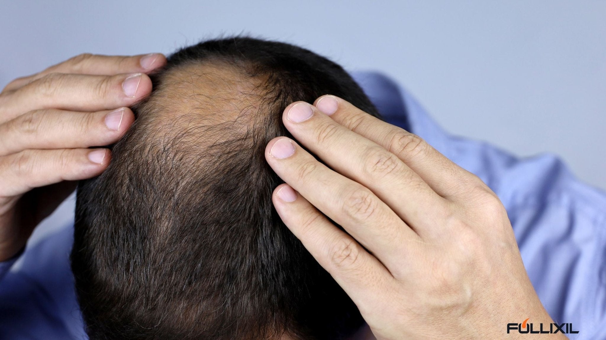 Understanding The Different Types Of Hair Loss: Causes And Solution 