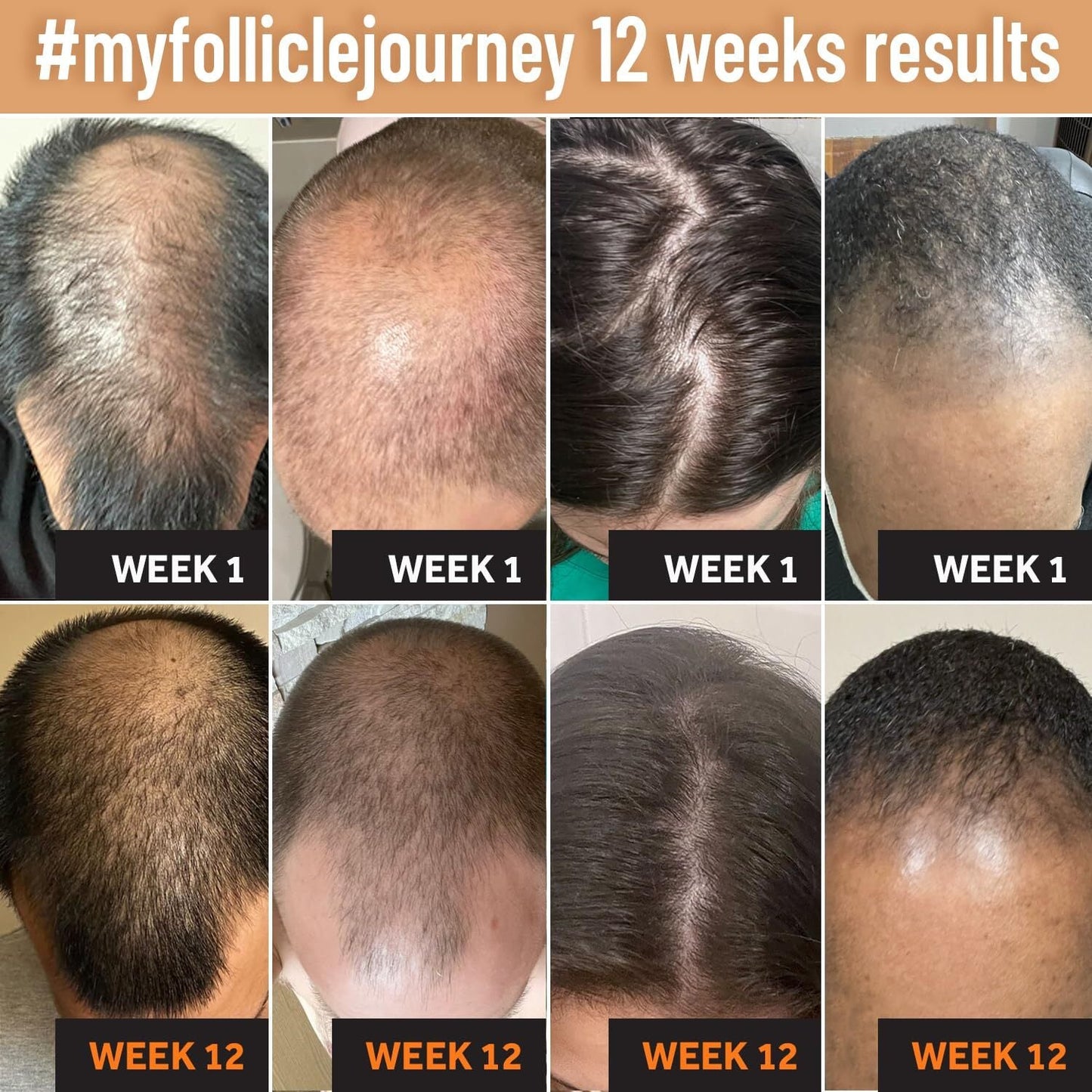 Follixil 5% Minoxidil - Foam - Follicle Booster