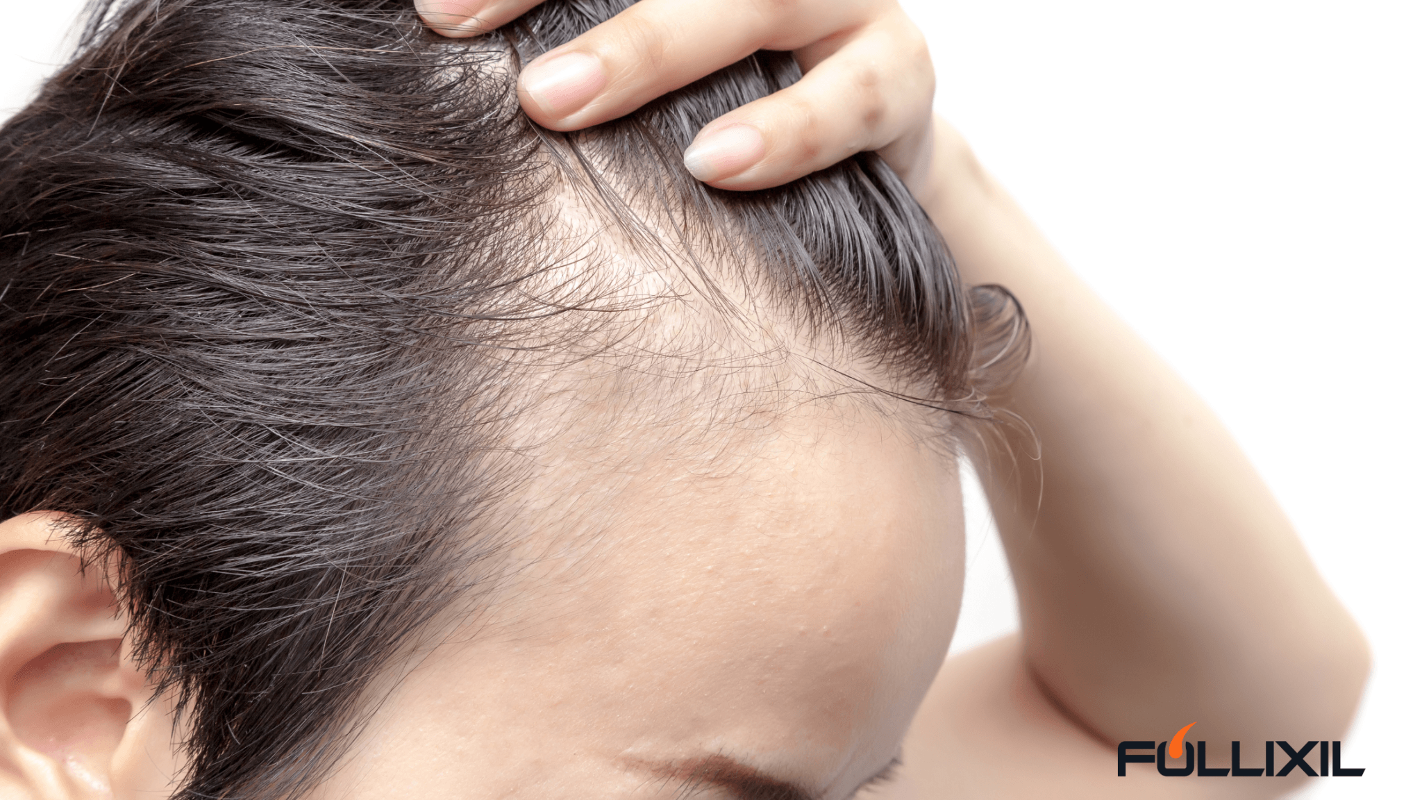 3 Types of Alopecia ( What are their differences?) - Follicle Booster